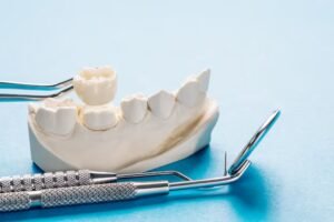 dental bridges in Santa Monica