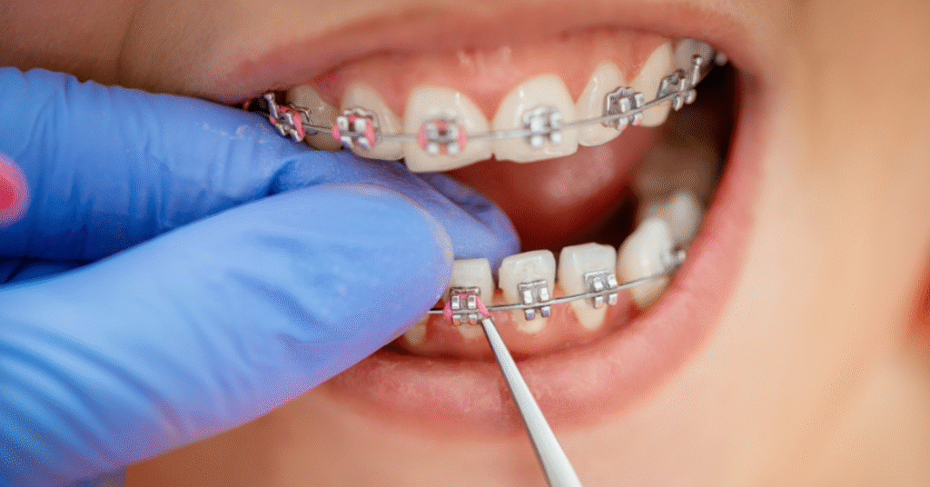 braces orthodontics