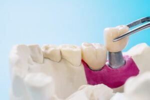 tooth crowns