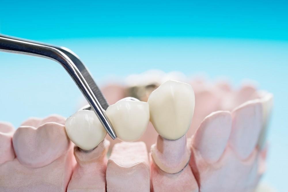 Tooth Crowns