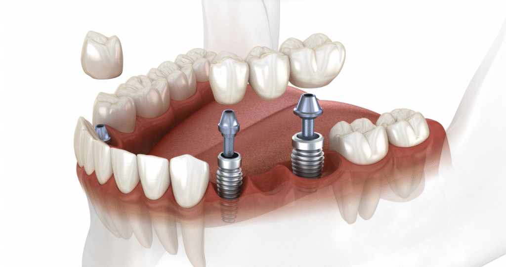 Dental Bridge