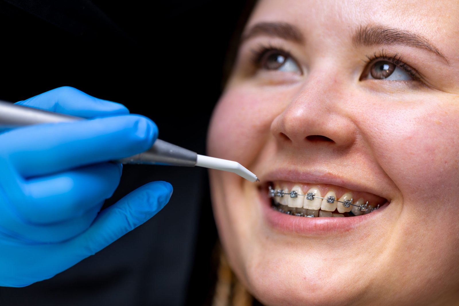Teeth Braces