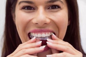 clear aligners