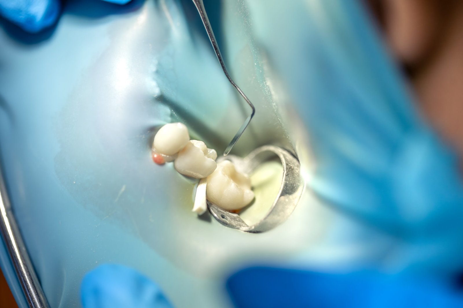 Tooth Extraction